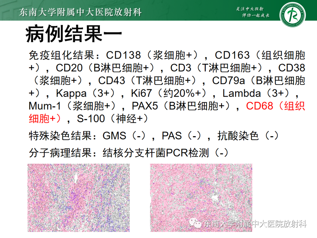 影像PPT - 【PPT】妇科疑难病例讨论3例-11 影像PPT - 【PPT】妇科疑难病例讨论3例-11
