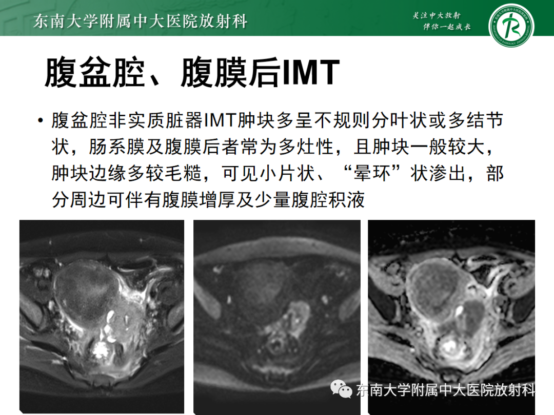 影像PPT - 【PPT】妇科疑难病例讨论3例-20 影像PPT - 【PPT】妇科疑难病例讨论3例-20