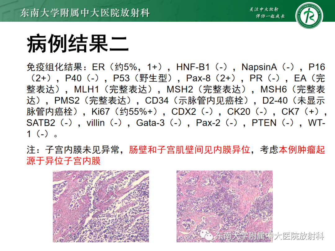 影像PPT - 【PPT】妇科疑难病例讨论3例-22 影像PPT - 【PPT】妇科疑难病例讨论3例-22