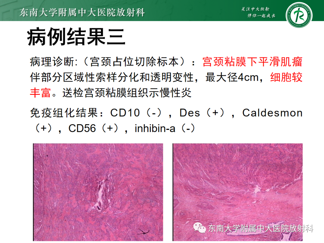 影像PPT - 【PPT】妇科疑难病例讨论3例-25 影像PPT - 【PPT】妇科疑难病例讨论3例-25