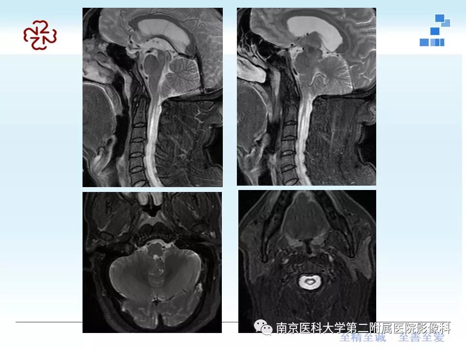 影像PPT - 【PPT】小脑扁桃体下疝畸形-3