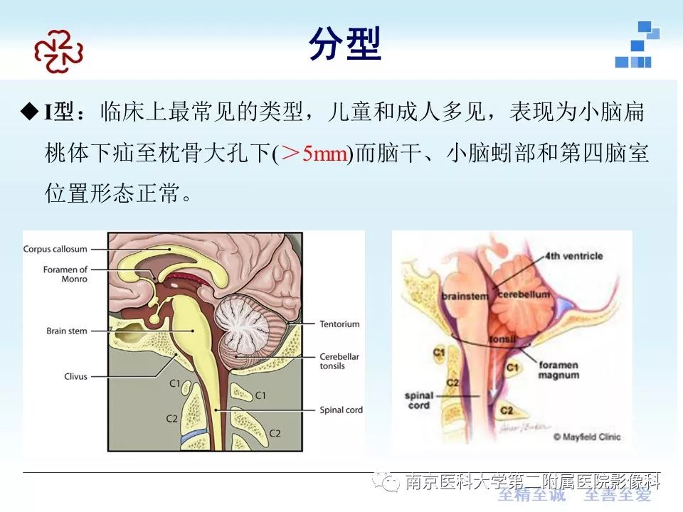 影像PPT - 【PPT】小脑扁桃体下疝畸形-9