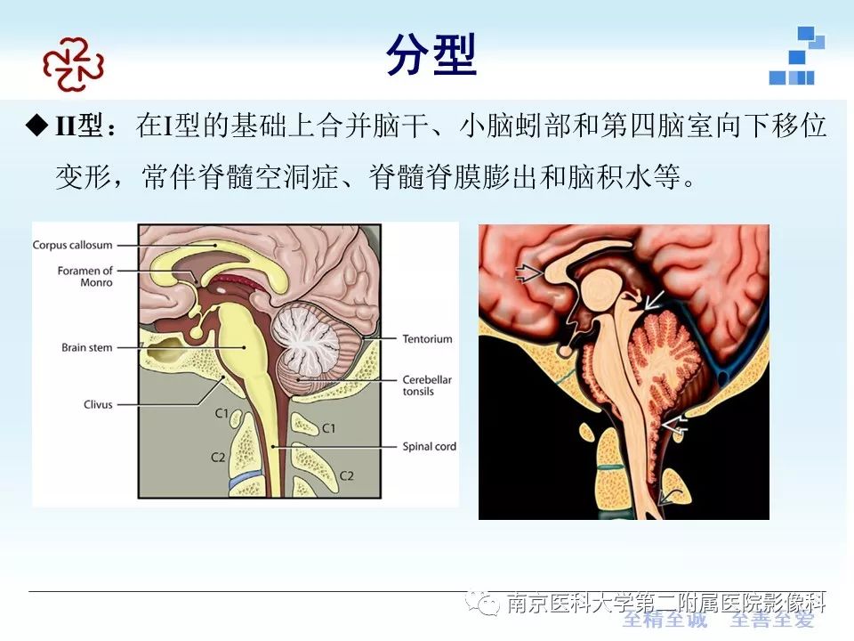 影像PPT - 【PPT】小脑扁桃体下疝畸形-11