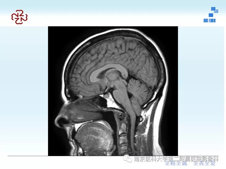 影像PPT - 【PPT】小脑扁桃体下疝畸形-15