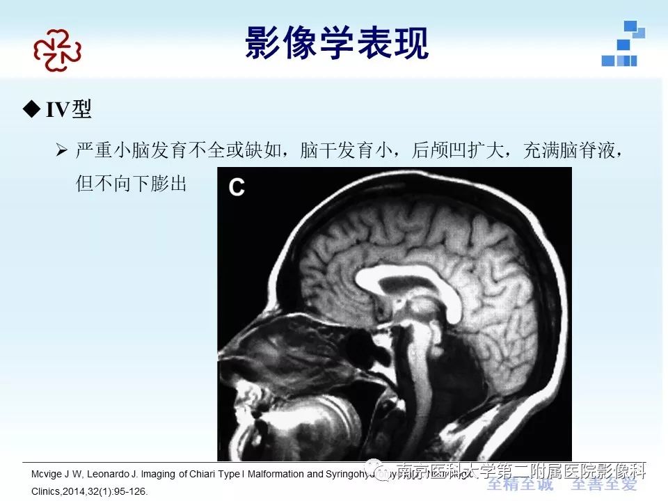 影像PPT - 【PPT】小脑扁桃体下疝畸形-20
