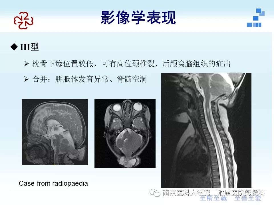 影像PPT - 【PPT】小脑扁桃体下疝畸形-19