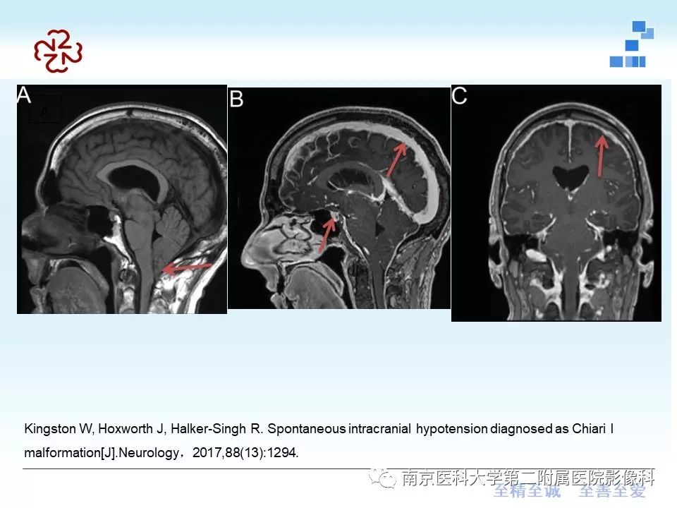 影像PPT - 【PPT】小脑扁桃体下疝畸形-23