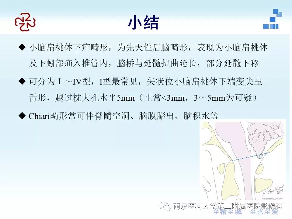 影像PPT - 【PPT】小脑扁桃体下疝畸形-25