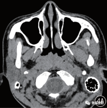 影像PPT - Rosai-Dorfman病临床病理及影像表现-5 影像PPT - Rosai-Dorfman病临床病理及影像表现-5