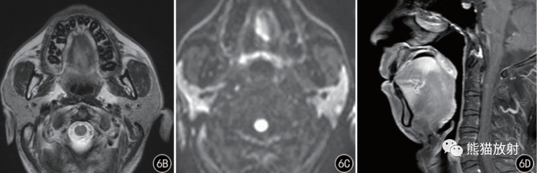影像PPT - Rosai-Dorfman病临床病理及影像表现-9 影像PPT - Rosai-Dorfman病临床病理及影像表现-9