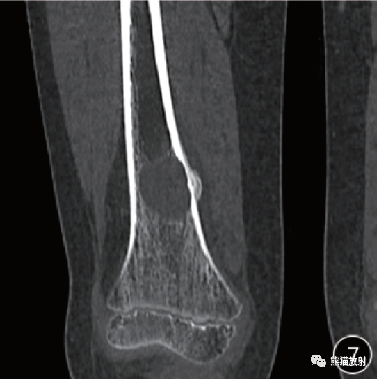 影像PPT - Rosai-Dorfman病临床病理及影像表现-10 影像PPT - Rosai-Dorfman病临床病理及影像表现-10