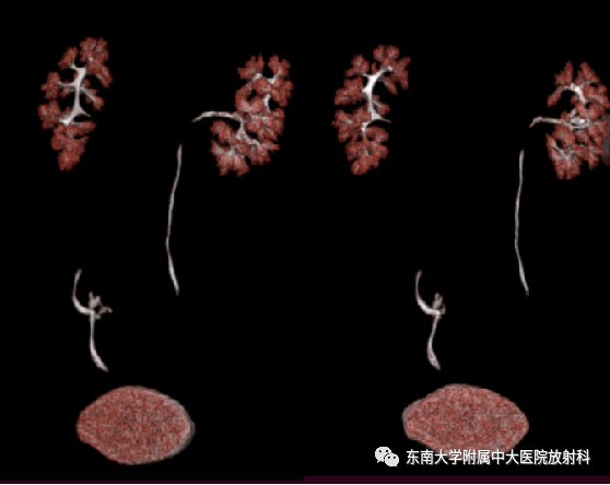 影像PPT - 【PPT】肾盂癌—Baron分型-7 影像PPT - 【PPT】肾盂癌—Baron分型-7
