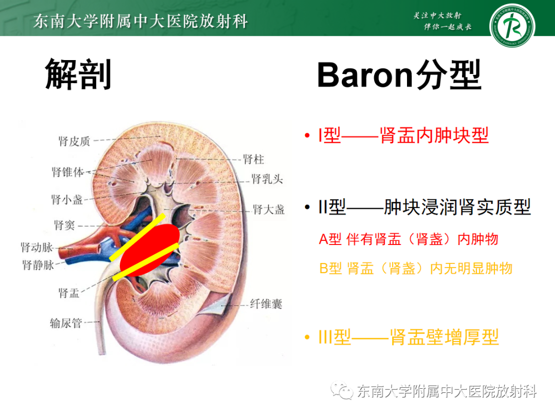 影像PPT - 【PPT】肾盂癌—Baron分型-10 影像PPT - 【PPT】肾盂癌—Baron分型-10