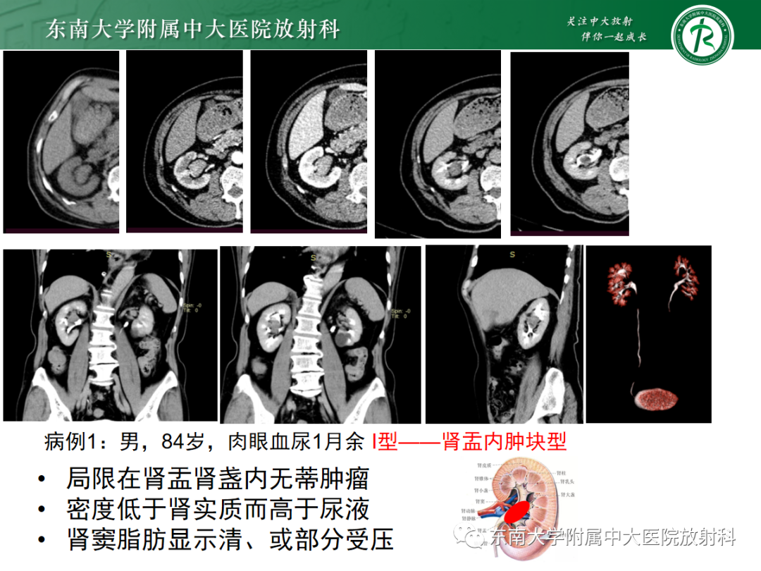 影像PPT - 【PPT】肾盂癌—Baron分型-17 影像PPT - 【PPT】肾盂癌—Baron分型-17