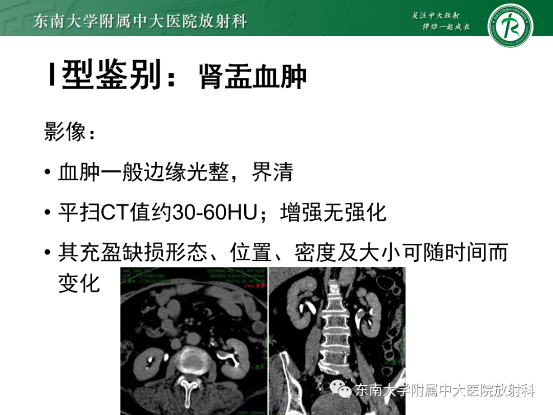 影像PPT - 【PPT】肾盂癌—Baron分型-19 影像PPT - 【PPT】肾盂癌—Baron分型-19
