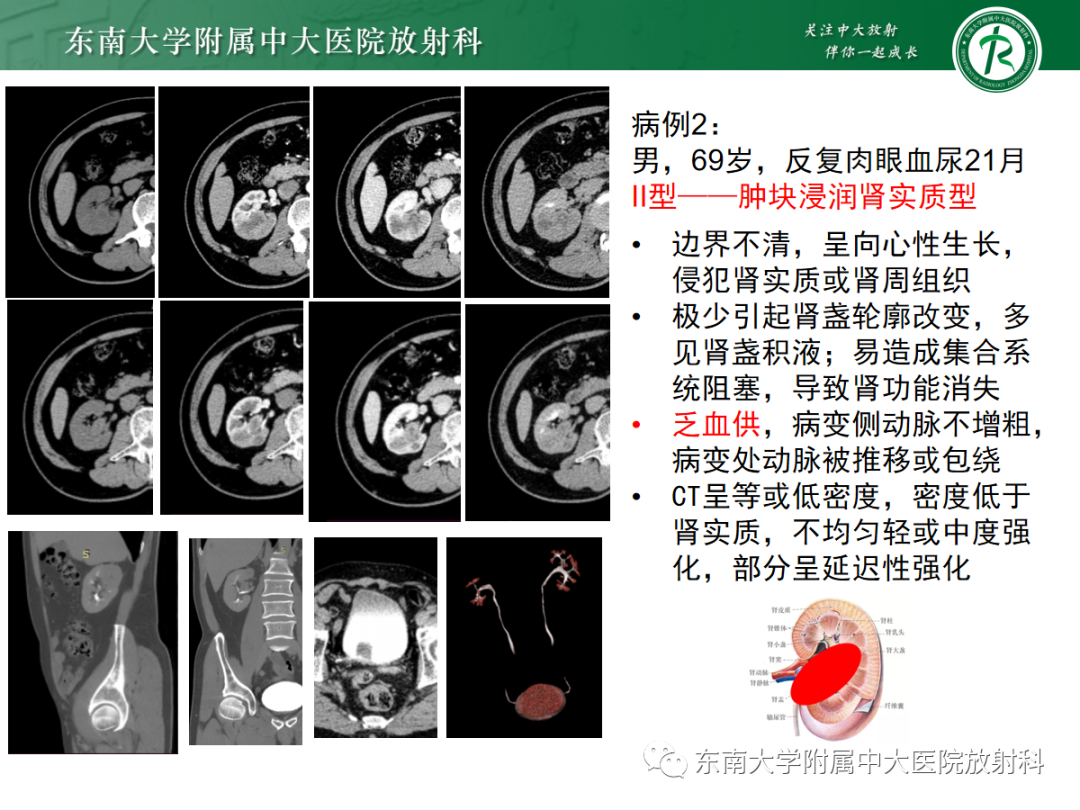 影像PPT - 【PPT】肾盂癌—Baron分型-21 影像PPT - 【PPT】肾盂癌—Baron分型-21
