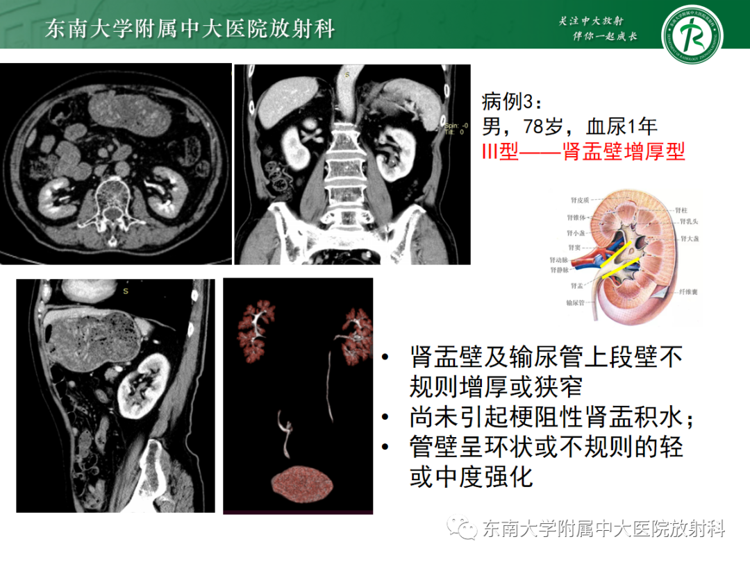 影像PPT - 【PPT】肾盂癌—Baron分型-22 影像PPT - 【PPT】肾盂癌—Baron分型-22