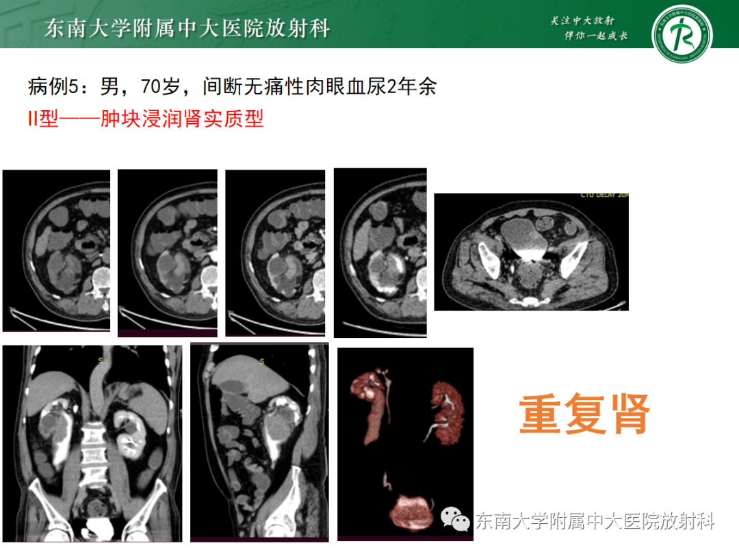 影像PPT - 【PPT】肾盂癌—Baron分型-28 影像PPT - 【PPT】肾盂癌—Baron分型-28