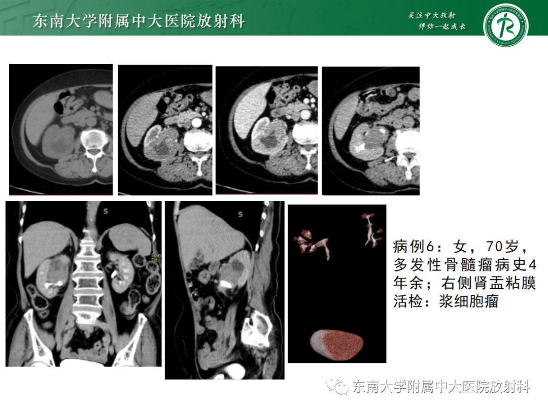 影像PPT - 【PPT】肾盂癌—Baron分型-29 影像PPT - 【PPT】肾盂癌—Baron分型-29