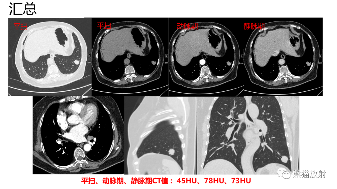 影像PPT - 【PPT】肺类癌2例CT影像-10