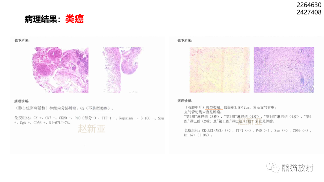 影像PPT - 【PPT】肺类癌2例CT影像-22