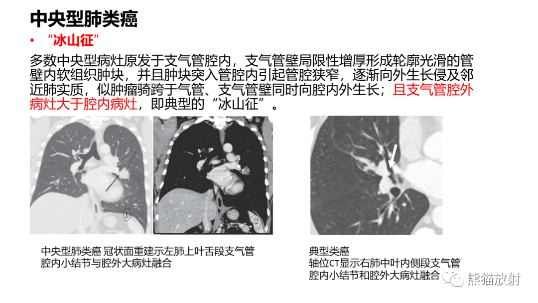 影像PPT - 【PPT】肺类癌2例CT影像-31