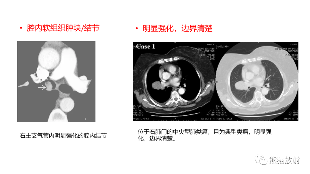 影像PPT - 【PPT】肺类癌2例CT影像-32