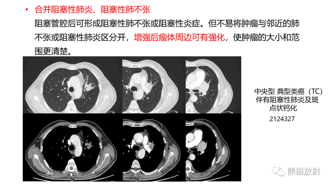 影像PPT - 【PPT】肺类癌2例CT影像-33