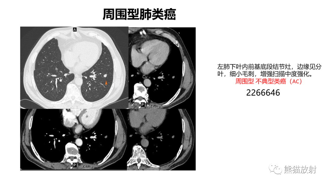 影像PPT - 【PPT】肺类癌2例CT影像-34