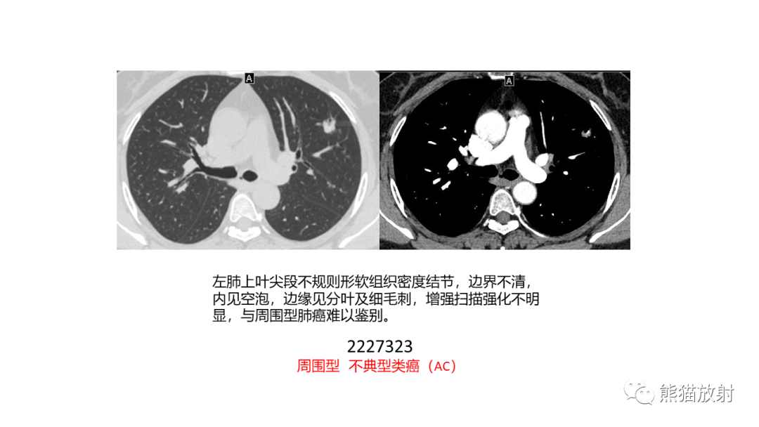 影像PPT - 【PPT】肺类癌2例CT影像-35