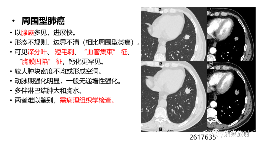 影像PPT - 【PPT】肺类癌2例CT影像-37