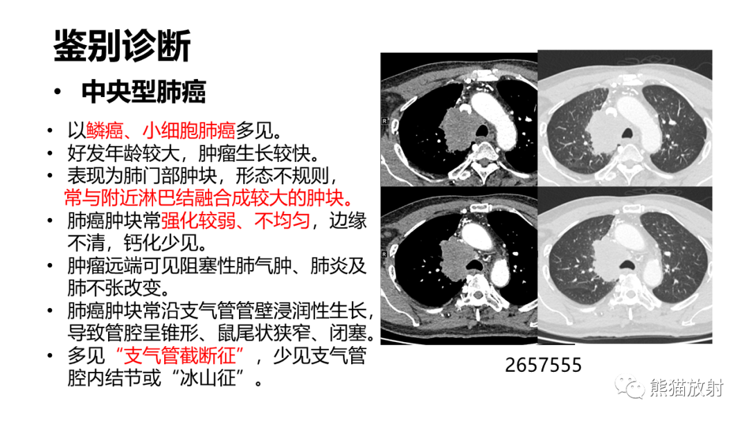 影像PPT - 【PPT】肺类癌2例CT影像-36