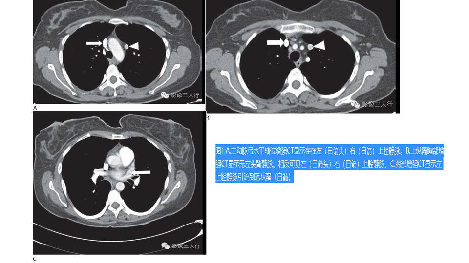 影像PPT - 【PPT】永存左上腔静脉 PLSVC-15