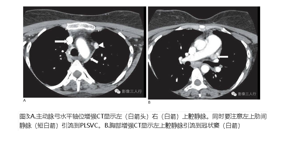 影像PPT - 【PPT】永存左上腔静脉 PLSVC-17
