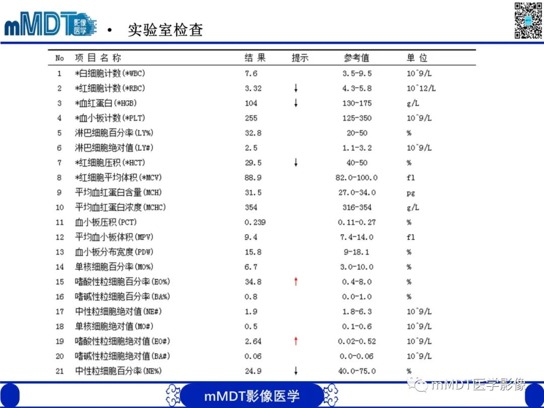 影像PPT - 【PPT】嗜酸粒细胞增多综合征-4 影像PPT - 【PPT】嗜酸粒细胞增多综合征-4