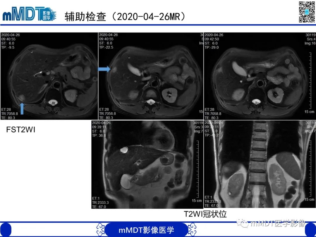 影像PPT - 【PPT】嗜酸粒细胞增多综合征-6 影像PPT - 【PPT】嗜酸粒细胞增多综合征-6