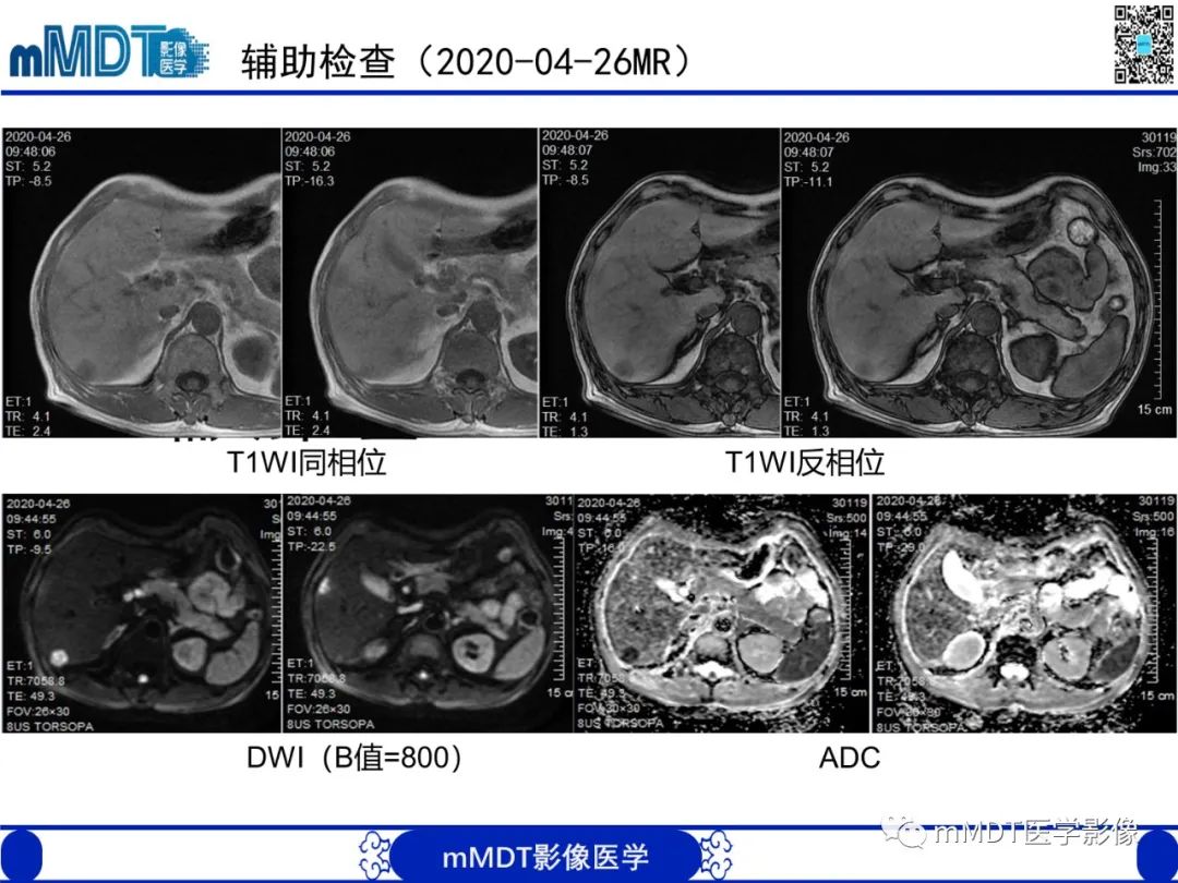 影像PPT - 【PPT】嗜酸粒细胞增多综合征-7 影像PPT - 【PPT】嗜酸粒细胞增多综合征-7