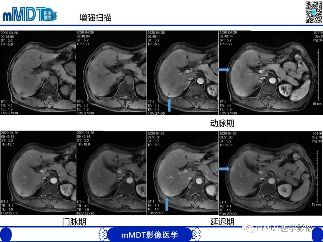 影像PPT - 【PPT】嗜酸粒细胞增多综合征-8 影像PPT - 【PPT】嗜酸粒细胞增多综合征-8