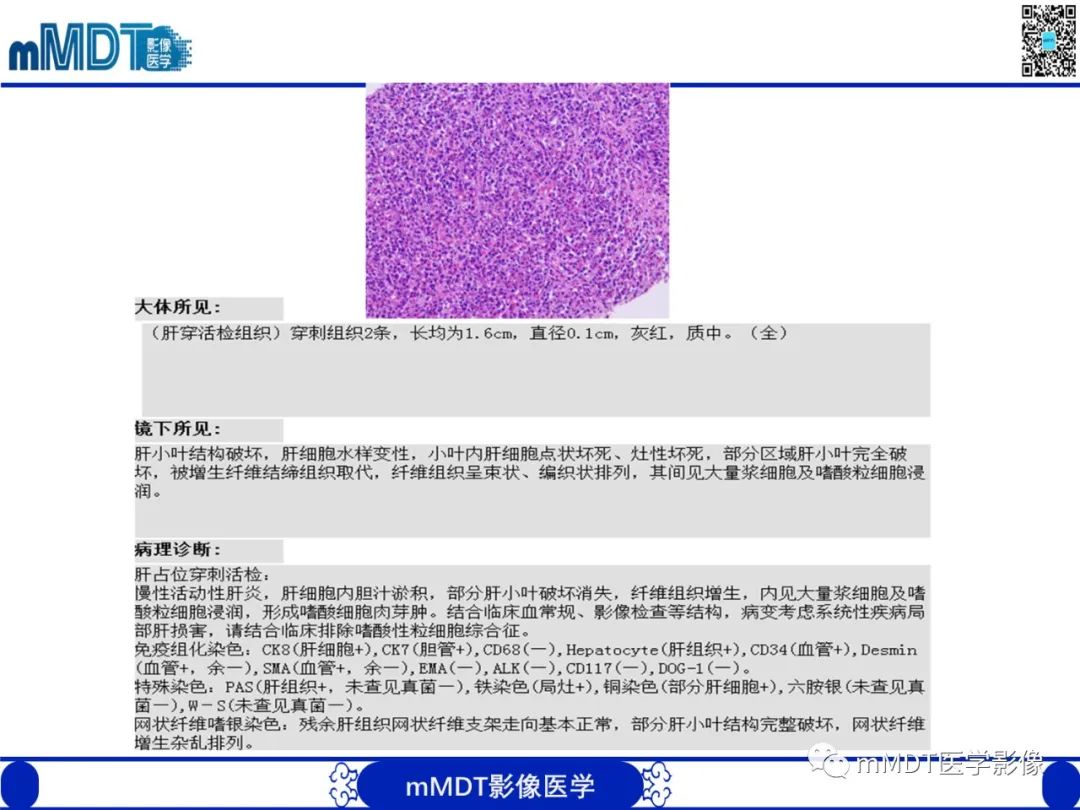 影像PPT - 【PPT】嗜酸粒细胞增多综合征-10 影像PPT - 【PPT】嗜酸粒细胞增多综合征-10