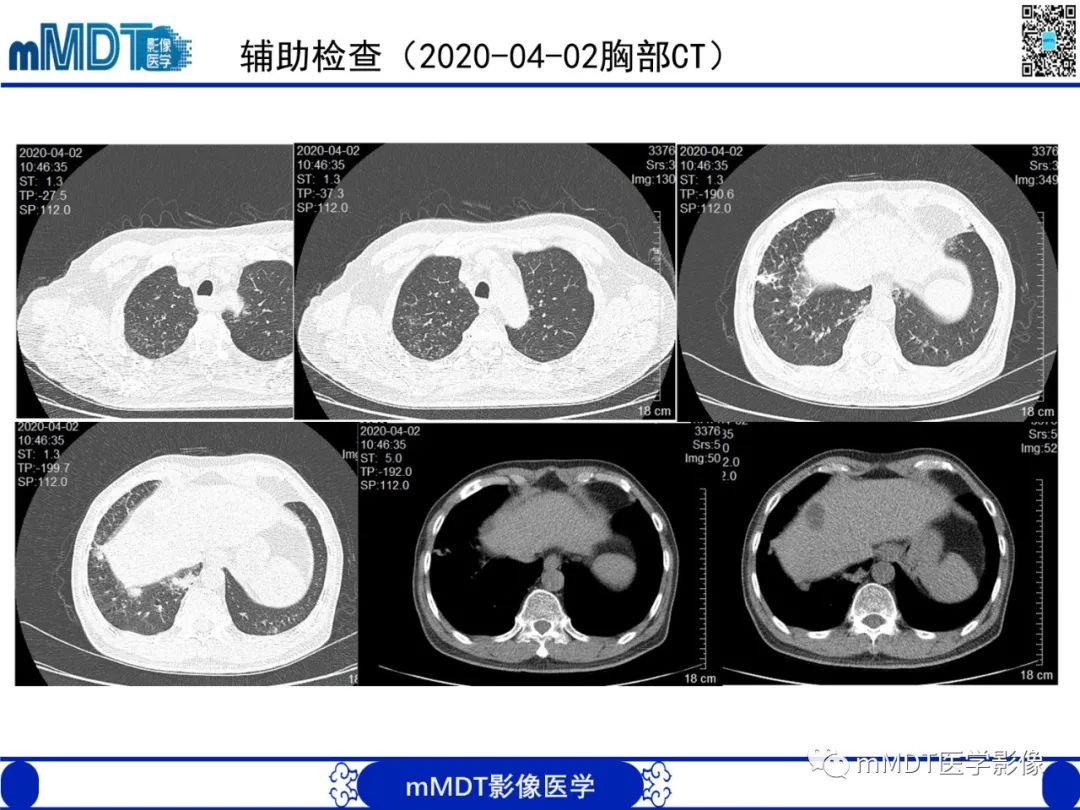 影像PPT - 【PPT】嗜酸粒细胞增多综合征-9 影像PPT - 【PPT】嗜酸粒细胞增多综合征-9