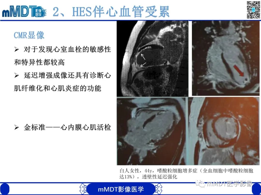 影像PPT - 【PPT】嗜酸粒细胞增多综合征-18 影像PPT - 【PPT】嗜酸粒细胞增多综合征-18