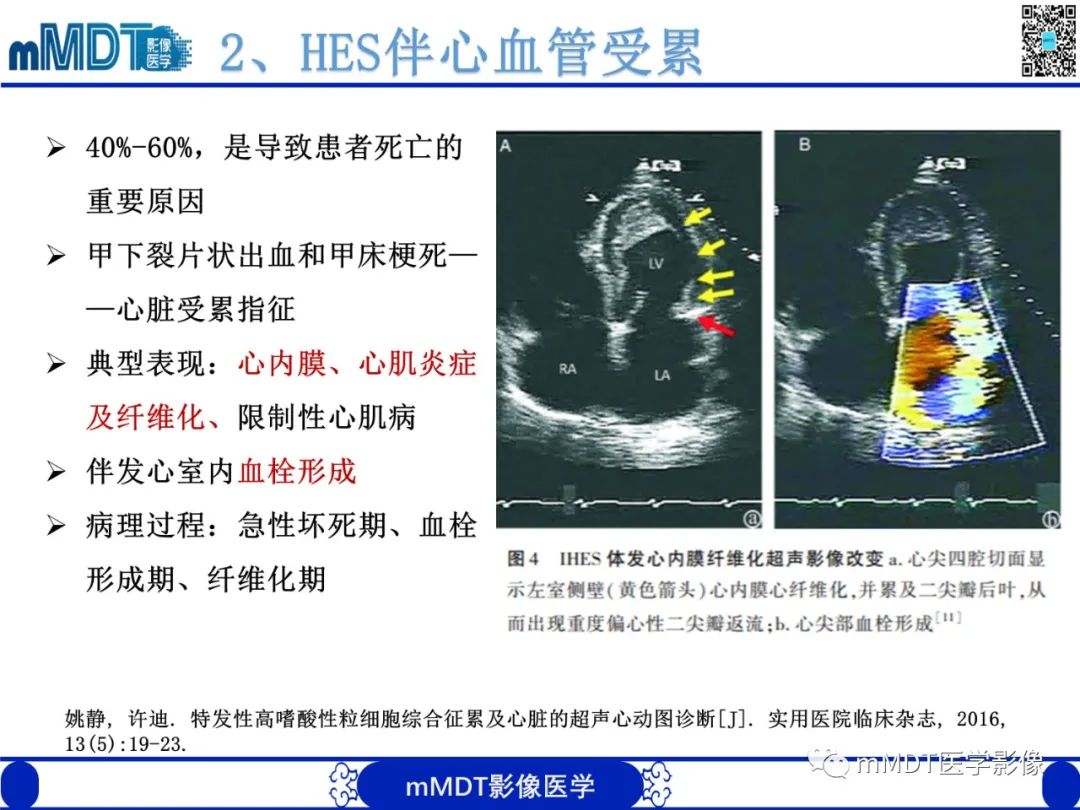 影像PPT - 【PPT】嗜酸粒细胞增多综合征-17 影像PPT - 【PPT】嗜酸粒细胞增多综合征-17
