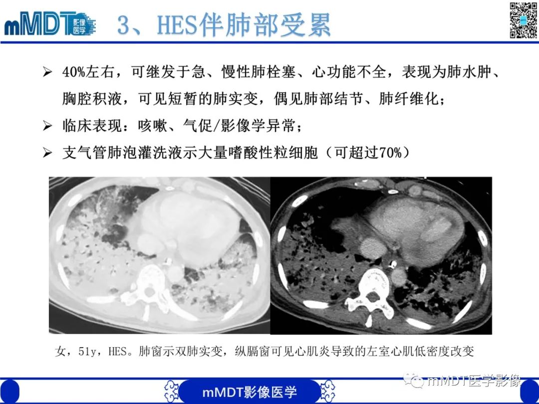 影像PPT - 【PPT】嗜酸粒细胞增多综合征-19 影像PPT - 【PPT】嗜酸粒细胞增多综合征-19