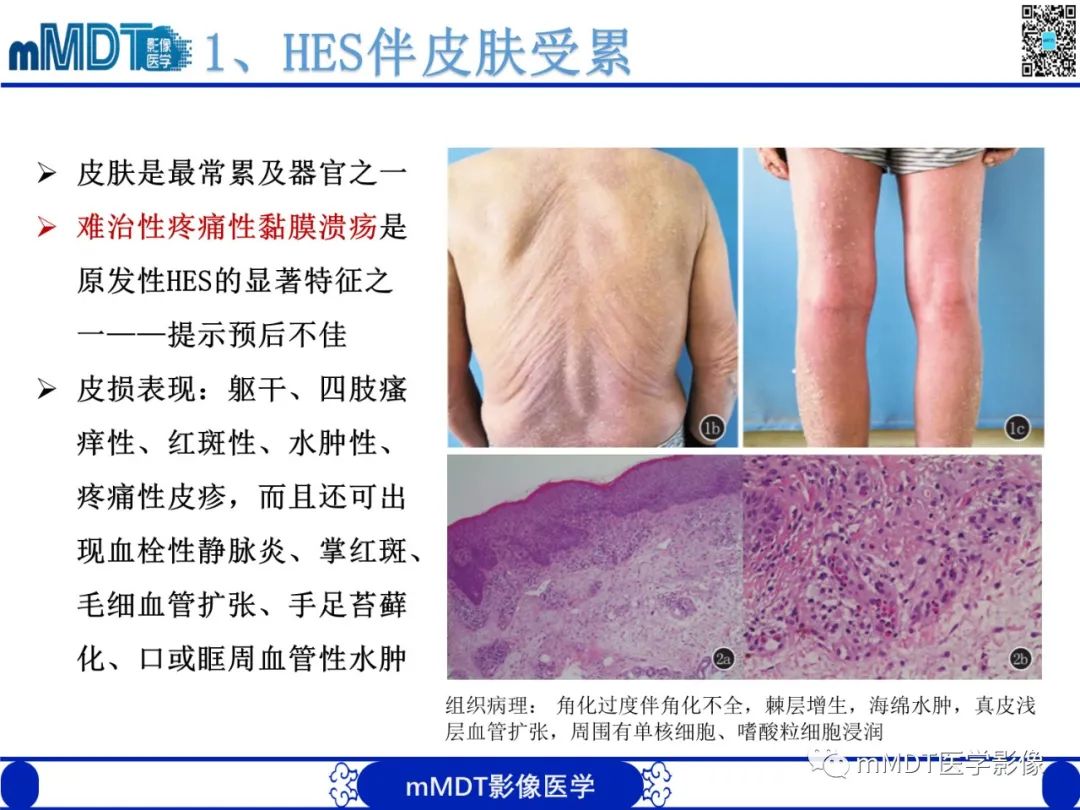 影像PPT - 【PPT】嗜酸粒细胞增多综合征-16 影像PPT - 【PPT】嗜酸粒细胞增多综合征-16
