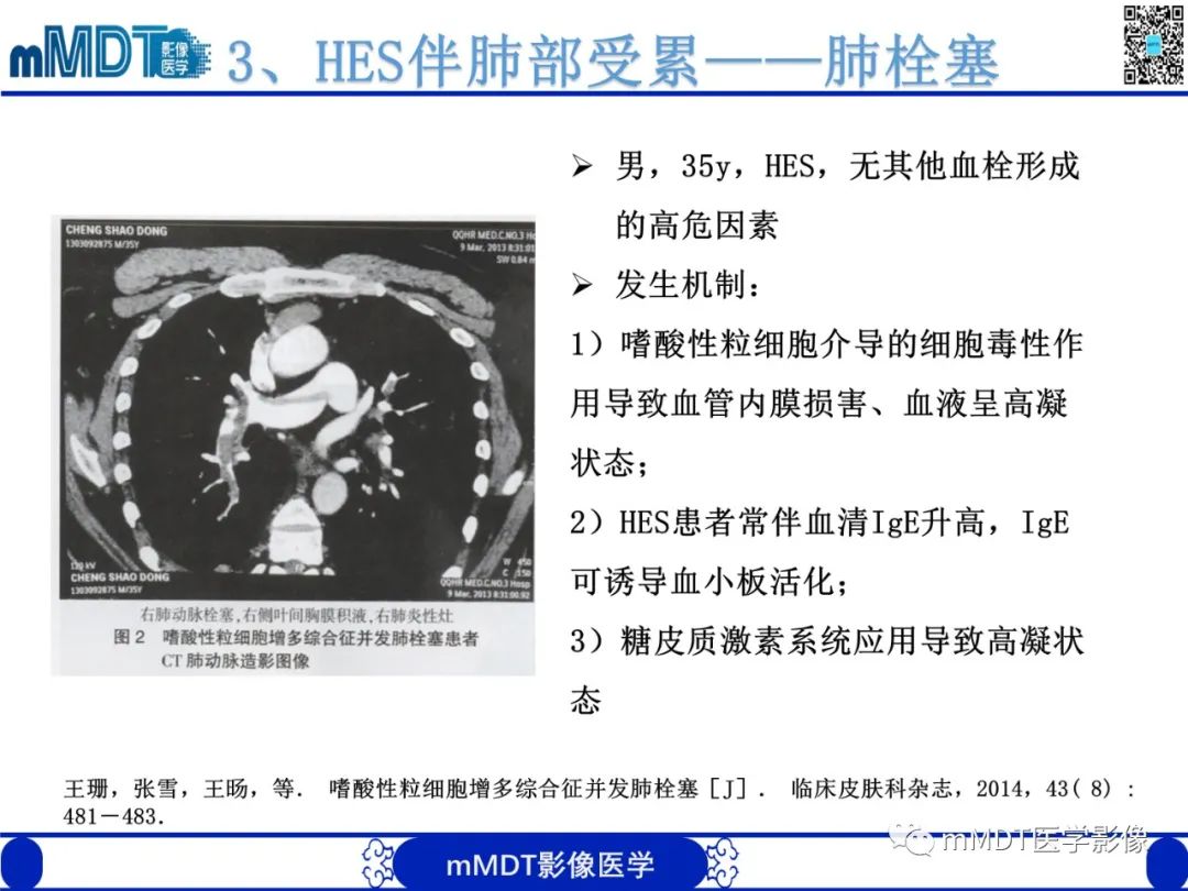 影像PPT - 【PPT】嗜酸粒细胞增多综合征-20 影像PPT - 【PPT】嗜酸粒细胞增多综合征-20