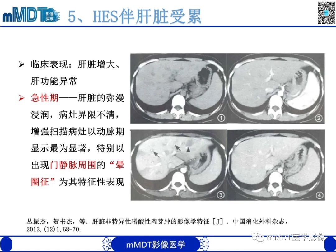影像PPT - 【PPT】嗜酸粒细胞增多综合征-24 影像PPT - 【PPT】嗜酸粒细胞增多综合征-24