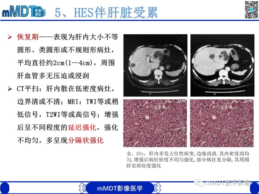 影像PPT - 【PPT】嗜酸粒细胞增多综合征-25 影像PPT - 【PPT】嗜酸粒细胞增多综合征-25