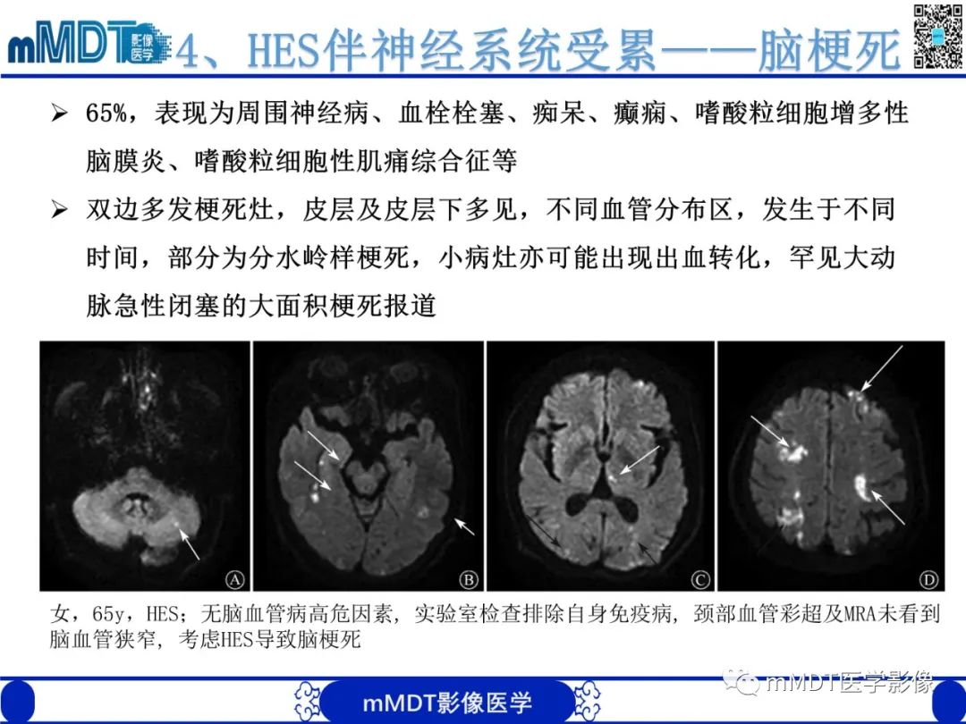 影像PPT - 【PPT】嗜酸粒细胞增多综合征-22 影像PPT - 【PPT】嗜酸粒细胞增多综合征-22