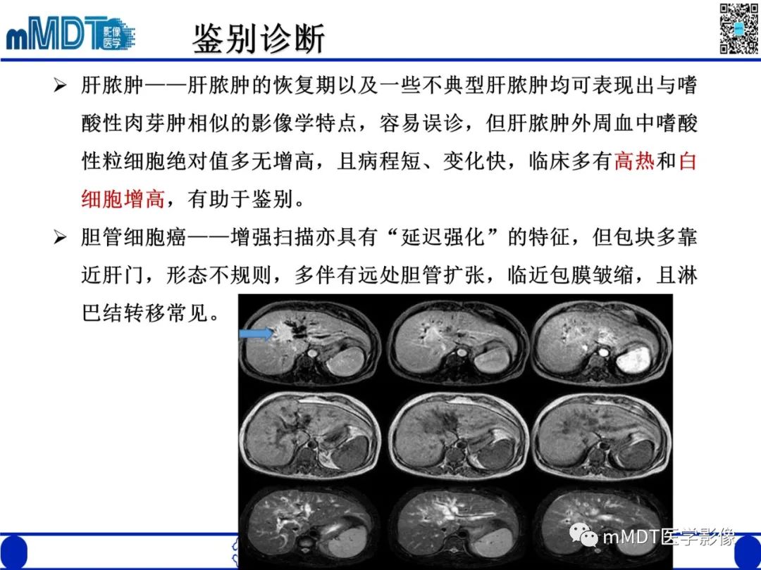 影像PPT - 【PPT】嗜酸粒细胞增多综合征-27 影像PPT - 【PPT】嗜酸粒细胞增多综合征-27