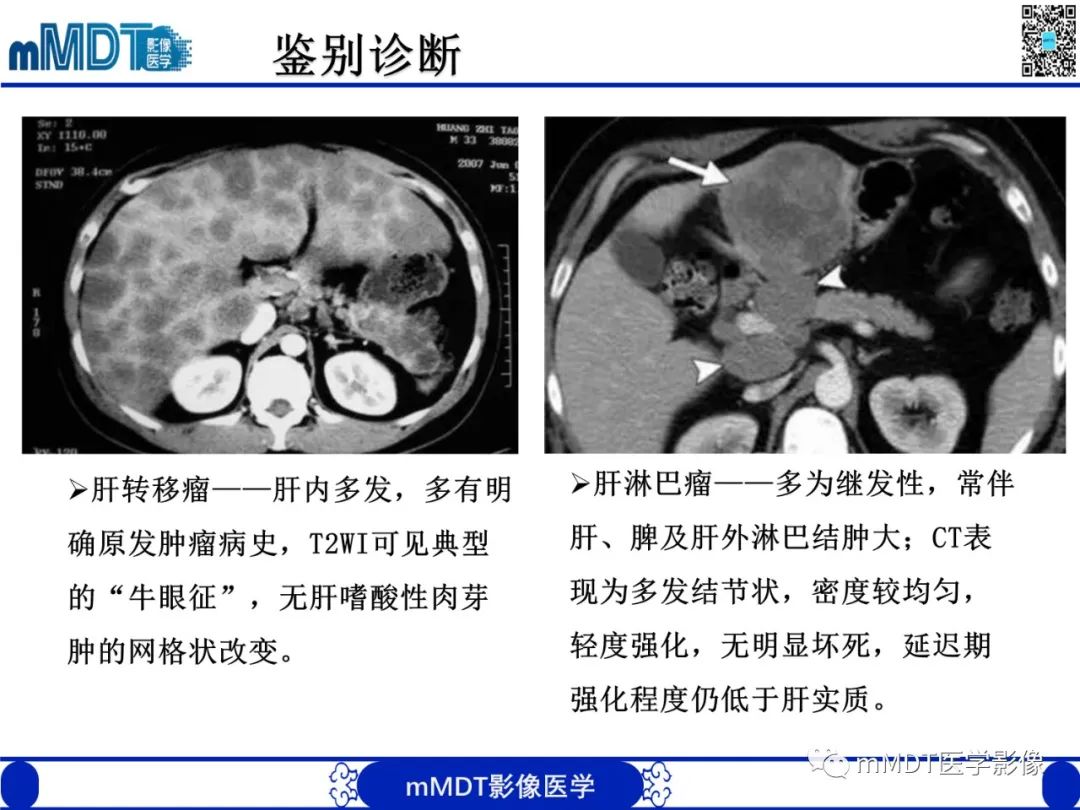 影像PPT - 【PPT】嗜酸粒细胞增多综合征-28 影像PPT - 【PPT】嗜酸粒细胞增多综合征-28